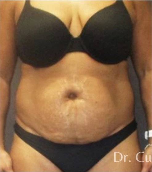 Before: Tummy Tuck & Lipo to Waist & Hips — front · by Angelo Cuzalina, MD, DDS