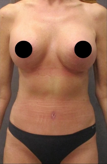 After: Breast Aug/Lift, Tummy Tuck, Lipo360 · by Angelo Cuzalina, MD, DDS