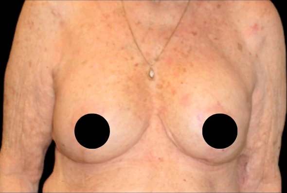 After: Breast Augmentation & Lift · by Angelo Cuzalina, MD, DDS