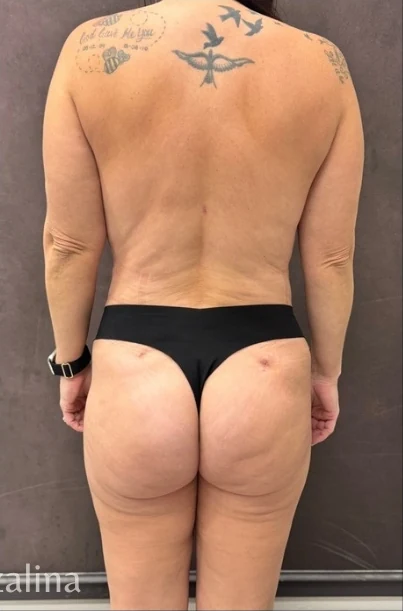 After: Mommy Makeover · by Angelo Cuzalina, MD, DDS