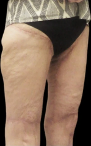 After: Thigh & Knee Lift — back · by Angelo Cuzalina, MD, DDS