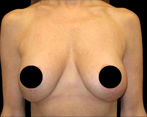 Before: Breast Aug/Lift · by Angelo Cuzalina, MD, DDS