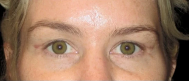 After: Upper Blepharoplasty — eyes-closeup · by Carisa Champion, DO