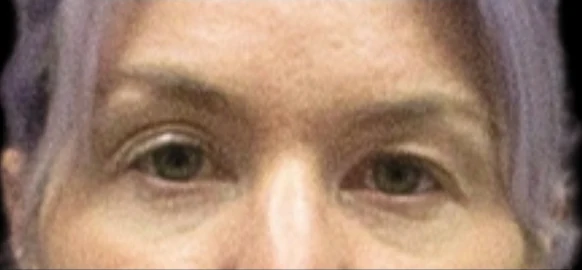 Before: Upper Blepharoplasty — eyes-closeup · by Carisa Champion, DO