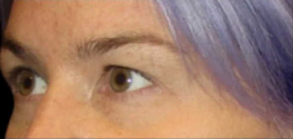 Before: Upper Blepharoplasty — profile-closeup · by Carisa Champion, DO