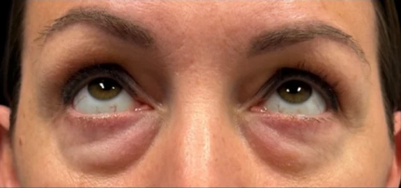 Before: Lower Blepharoplasty · by Angelo Cuzalina, MD, DDS
