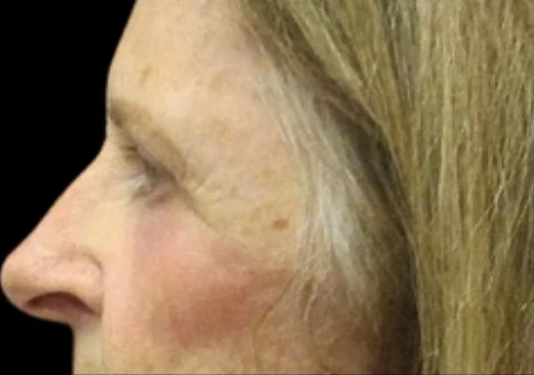 After: Upper/Lower Blephs & Laser Resurfacing — profile-closeup · by Angelo Cuzalina, MD, DDS