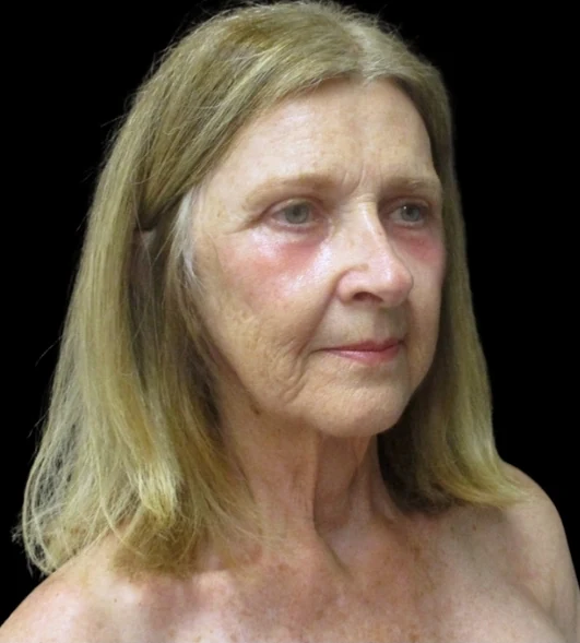 After: Upper/Lower Blephs & Laser Resurfacing — three-quarter · by Angelo Cuzalina, MD, DDS