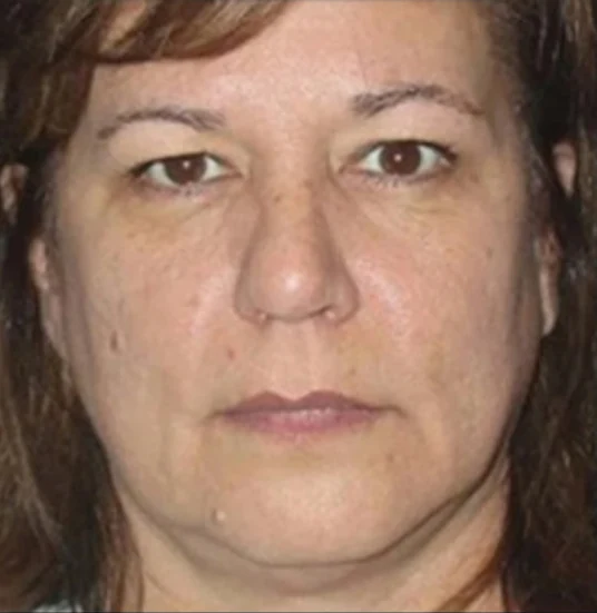 Before: Upper Blephs · by Angelo Cuzalina, MD, DDS