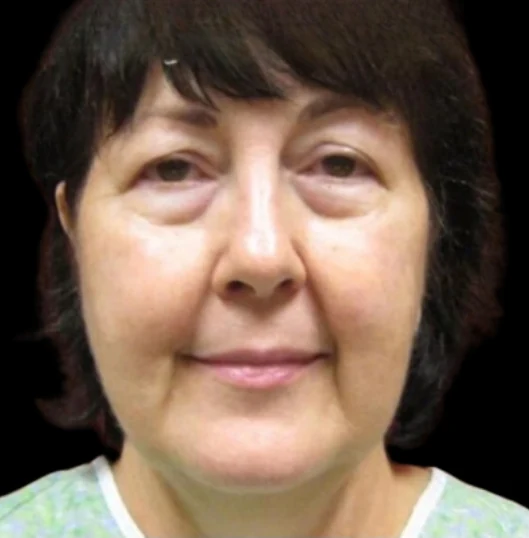 Before: Blepharoplasty · by Angelo Cuzalina, MD, DDS