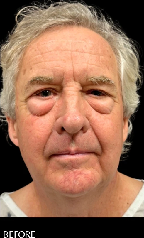 Before: Blepharoplasty — front · by Angelo Cuzalina, MD, DDS