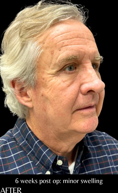 After: Blepharoplasty — three-quarter · by Angelo Cuzalina, MD, DDS