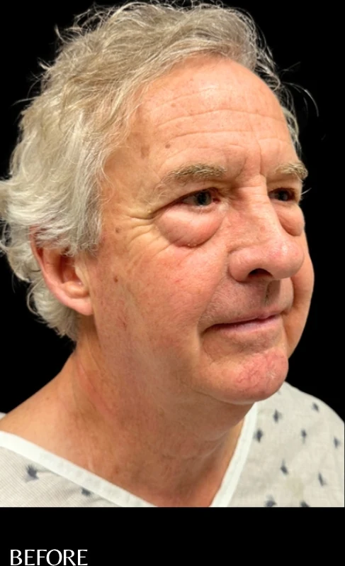 Before: Blepharoplasty — three-quarter · by Angelo Cuzalina, MD, DDS