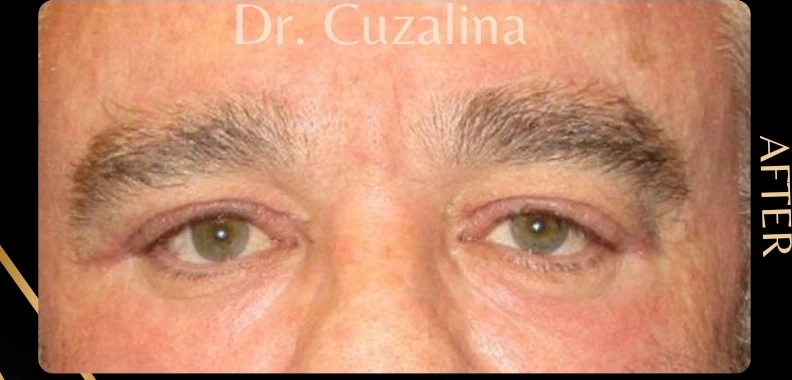 After: Upper Eye Bleph w/ Fat Grafting Below the Eyes · by Angelo Cuzalina, MD, DDS