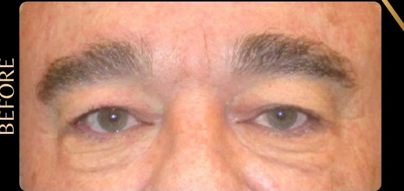 Before: Upper Eye Bleph w/ Fat Grafting Below the Eyes · by Angelo Cuzalina, MD, DDS