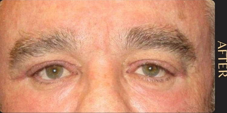 After: Upper Eye Bleph w/ Fat Grafting Below the Eyes · by Angelo Cuzalina, MD, DDS