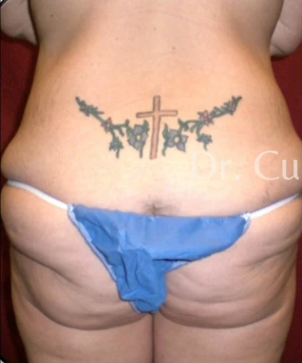 Before: Brazilian Butt Lift + Formal Butt Lift · by Angelo Cuzalina, MD, DDS