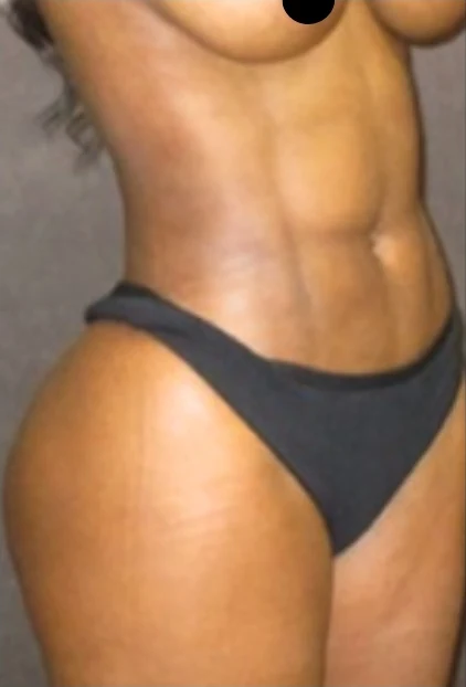 After: Brazilian Butt Lift & Hidef Lipo — oblique · by Angelo Cuzalina, MD, DDS