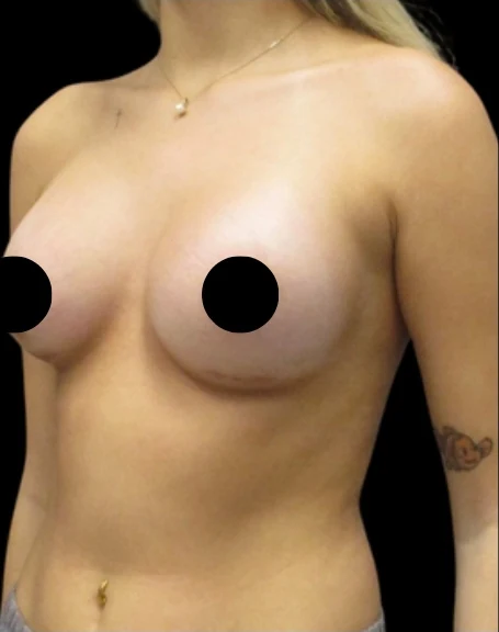 After: Breast Augmentation — front · by Carisa Champion, DO