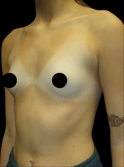 Before: Breast Augmentation — front · by Carisa Champion, DO