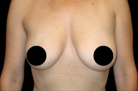 Before: Breast Augmentation · by Sebastian Gutierrez, MD