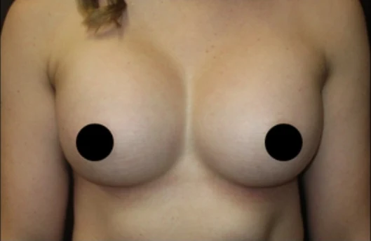 After: Breast Augmentation · by Angelo Cuzalina, MD, DDS