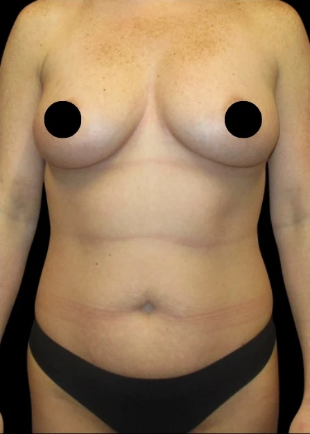 Before: Breast Augmentation, Full Tummy Tuck, Lipo to Hips, BBL · by Angelo Cuzalina, MD, DDS
