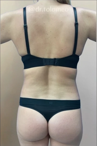 Before: Breast Aug & Hidef Lipo — back · by Pasquale Tolomeo, MD