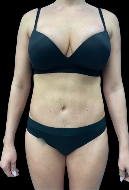 Before: Breast Aug & Hidef Lipo — front · by Pasquale Tolomeo, MD