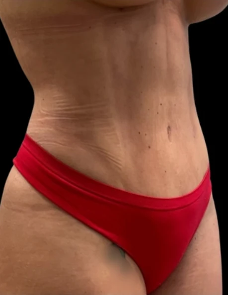 After: Breast Aug & Hidef Lipo — front-torso · by Pasquale Tolomeo, MD