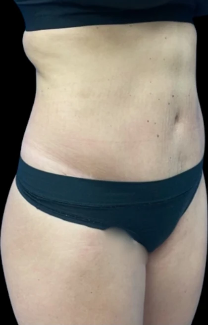 Before: Breast Aug & Hidef Lipo — front-torso · by Pasquale Tolomeo, MD