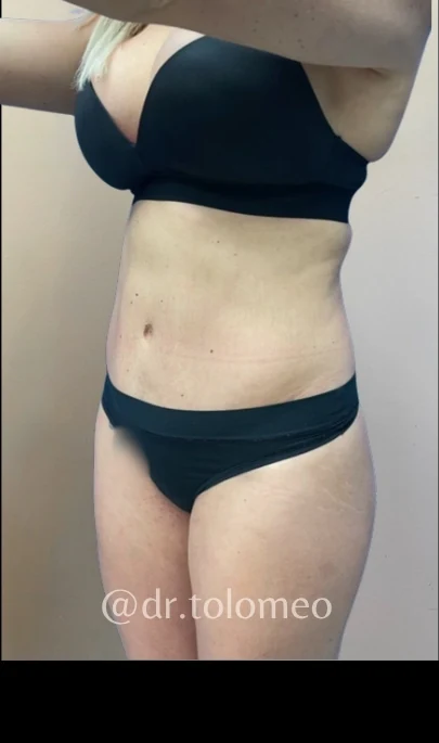Before: Breast Aug & Hidef Lipo — oblique · by Pasquale Tolomeo, MD