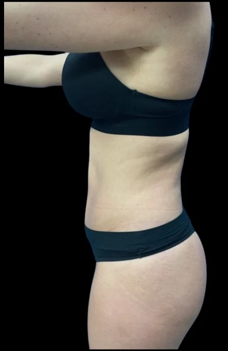 Before: Breast Aug & Hidef Lipo — profile · by Pasquale Tolomeo, MD