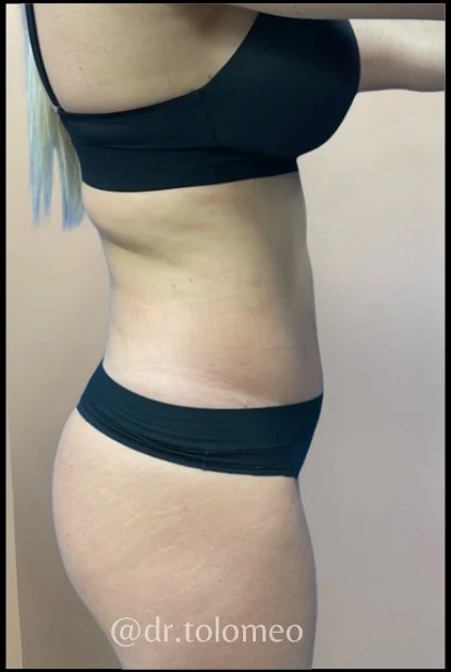 Before: Breast Aug & Hidef Lipo — three-quarter · by Pasquale Tolomeo, MD