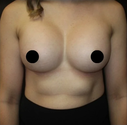 After: Breast Augmentation — front · by Angelo Cuzalina, MD, DDS