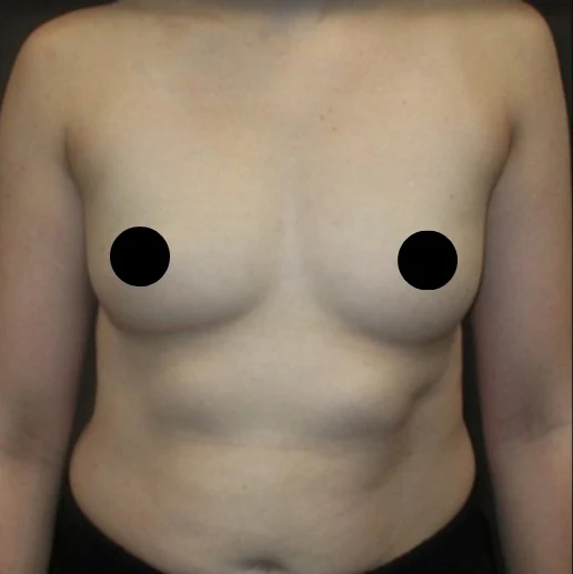 Before: Breast Augmentation — front · by Angelo Cuzalina, MD, DDS