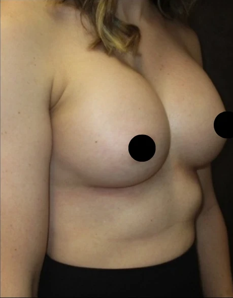 After: Breast Augmentation — oblique · by Angelo Cuzalina, MD, DDS