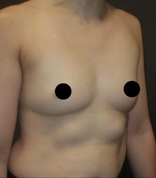 Before: Breast Augmentation — oblique · by Angelo Cuzalina, MD, DDS