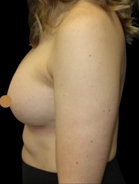 After: Breast Augmentation — profile · by Angelo Cuzalina, MD, DDS