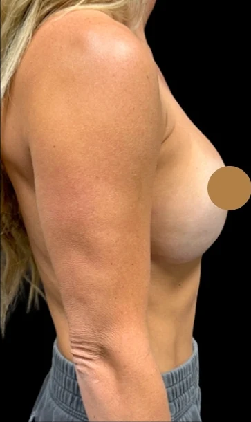 Before: Breast Augmentation — oblique · by Angelo Cuzalina, MD, DDS