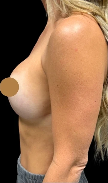 Before: Breast Augmentation — profile · by Angelo Cuzalina, MD, DDS