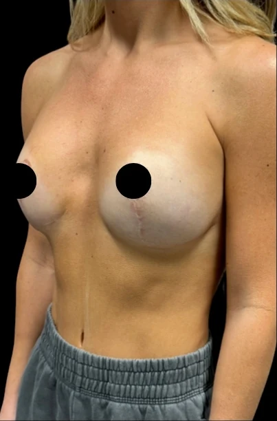 Before: Breast Augmentation — three-quarter · by Angelo Cuzalina, MD, DDS
