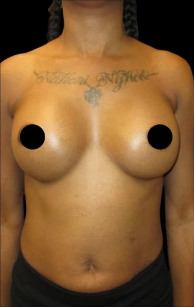 After: Breast Augmentation — front · by Angelo Cuzalina, MD, DDS