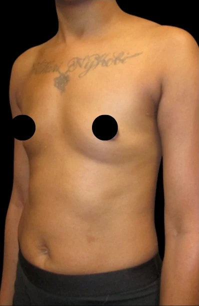 Before: Breast Augmentation — oblique · by Angelo Cuzalina, MD, DDS