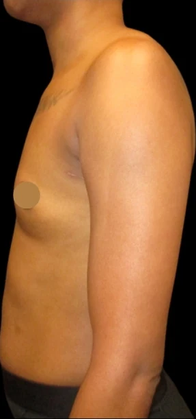 Before: Breast Augmentation — profile · by Angelo Cuzalina, MD, DDS