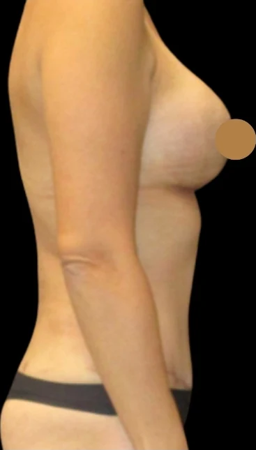 After: Breast Augmentation, Tummy Tuck, Lipo360 · by Angelo Cuzalina, MD, DDS