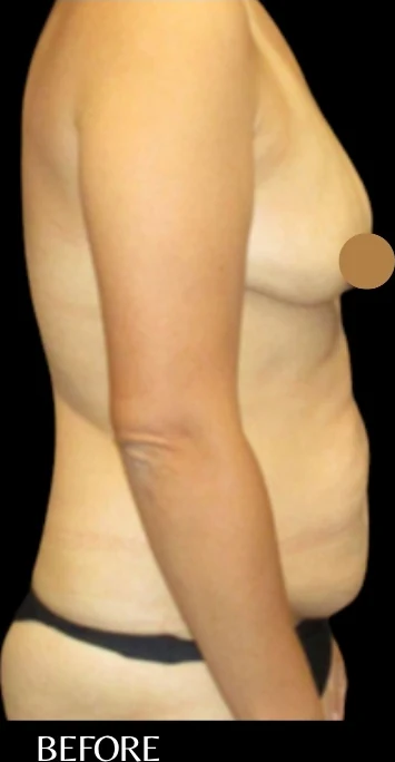 Before: Breast Augmentation, Tummy Tuck, Lipo360 · by Angelo Cuzalina, MD, DDS
