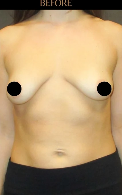 Before: Breast Augmentation · by Angelo Cuzalina, MD, DDS