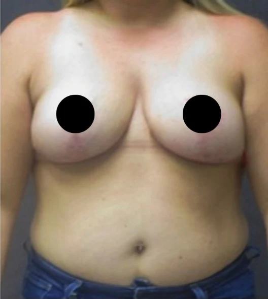 After: Breast Lift · by Angelo Cuzalina, MD, DDS