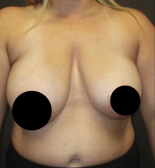 Before: Breast Lift · by Angelo Cuzalina, MD, DDS